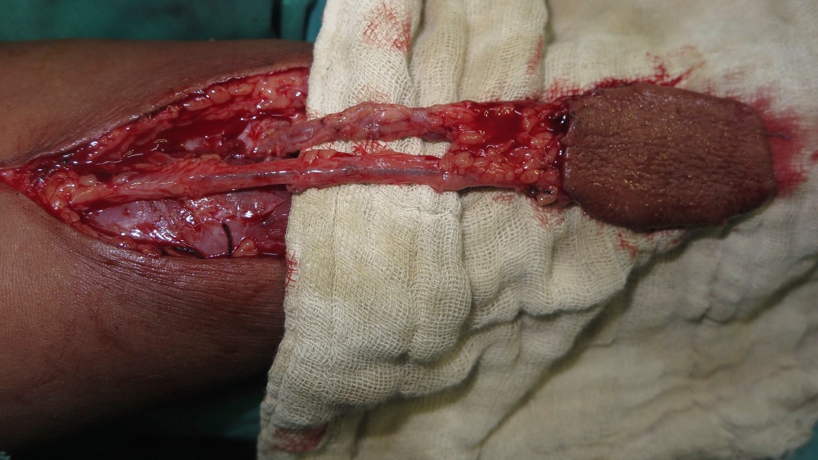Dr Manish Tiwari ALT Flap Microvascular Surgeon