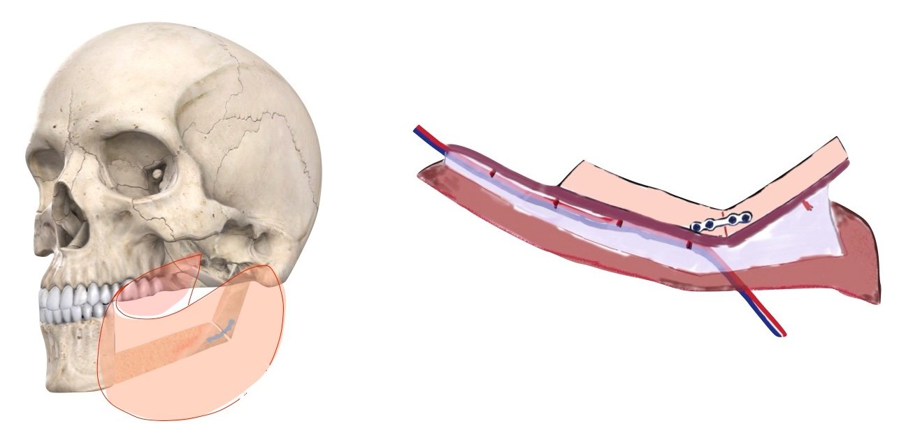 Microvascular Free Flap Surgery